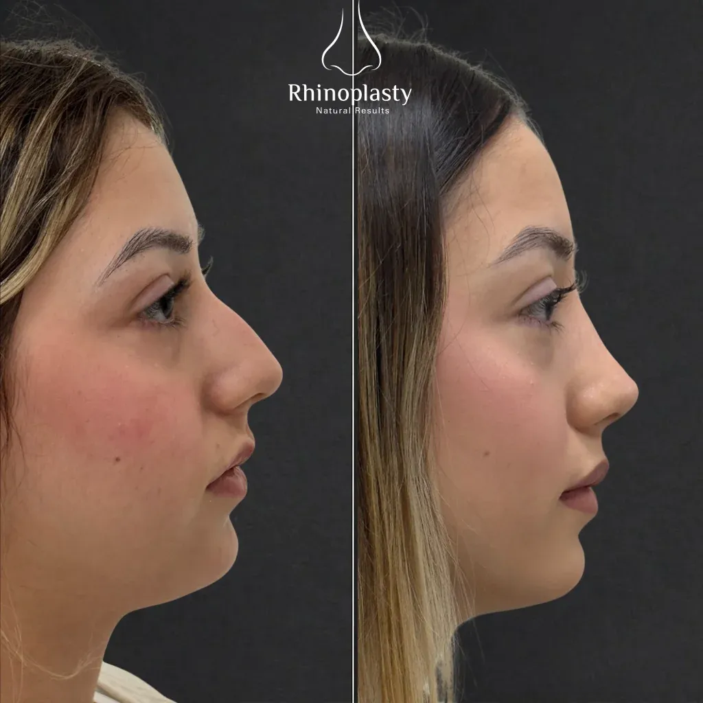 Rhinoplasty before and after — published with the patient's written consent