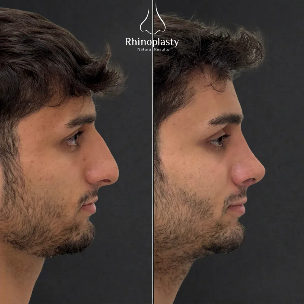 Rhinoplasty before and after — published with the patient's written consent