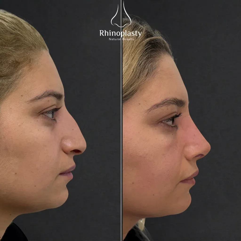 Rhinoplasty before and after — published with the patient's written consent