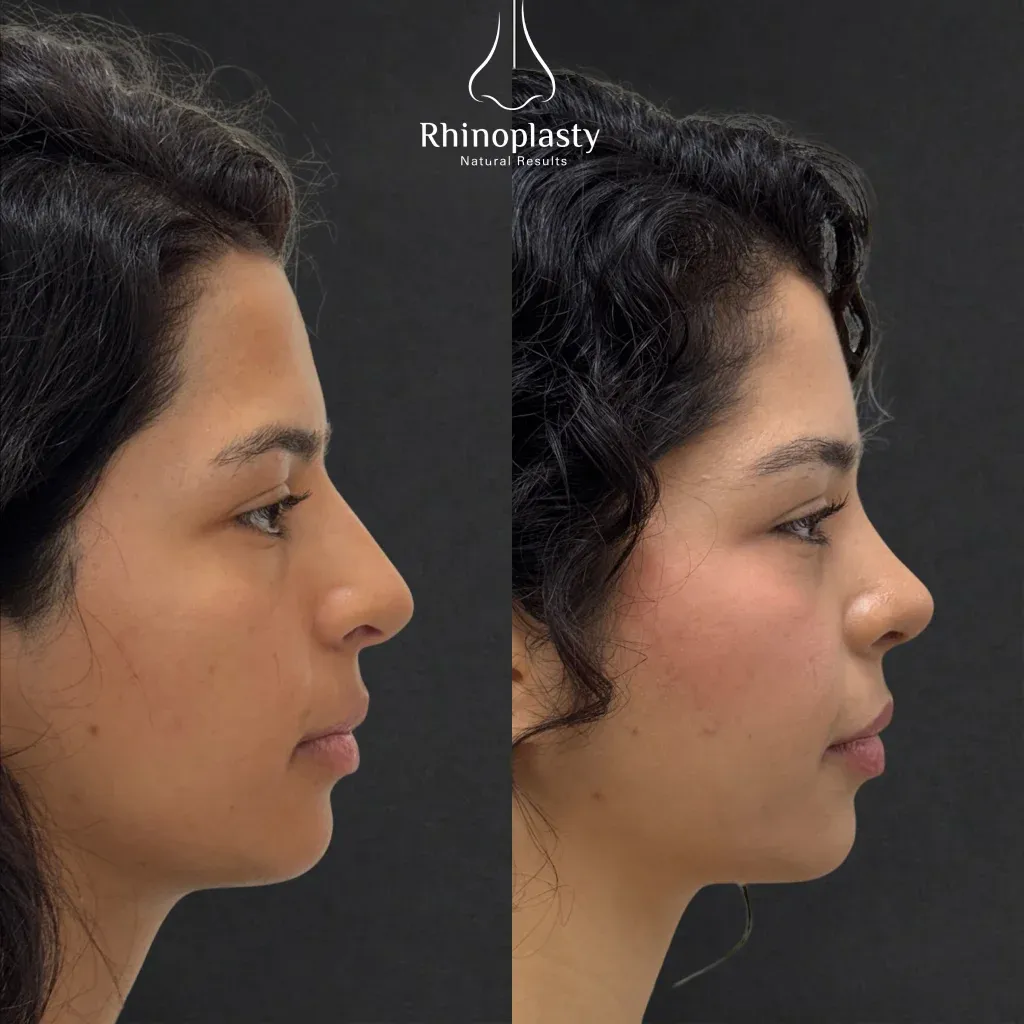 Rhinoplasty before and after — published with the patient's written consent