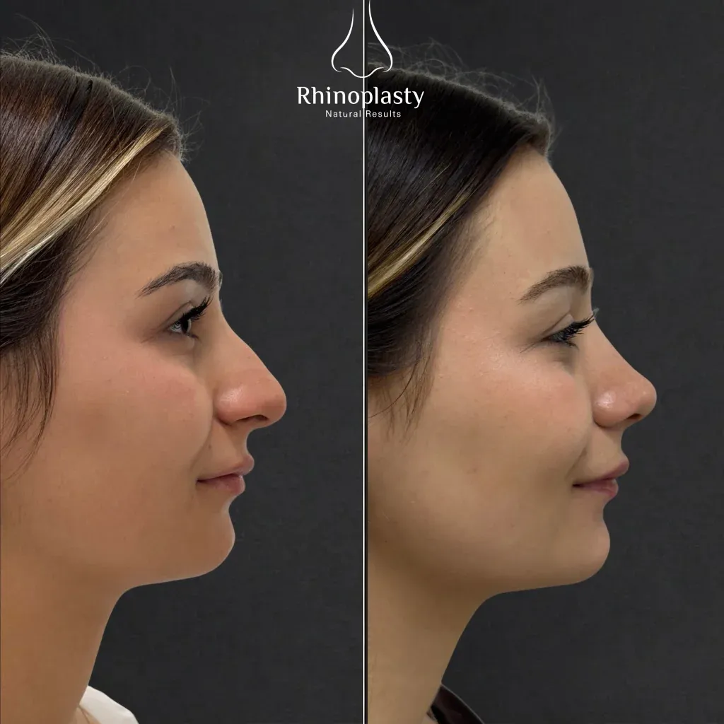 Rhinoplasty before and after — published with the patient's written consent