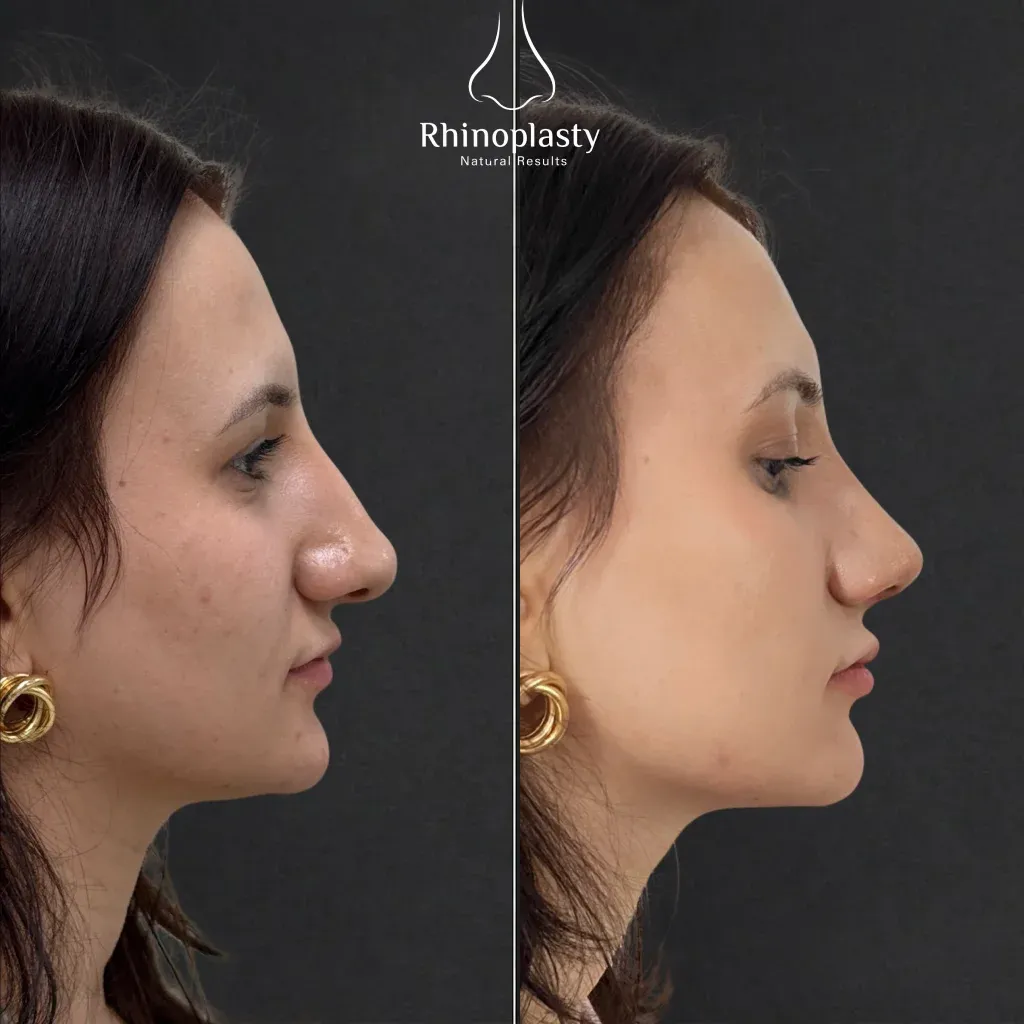 Rhinoplasty before and after — published with the patient's written consent