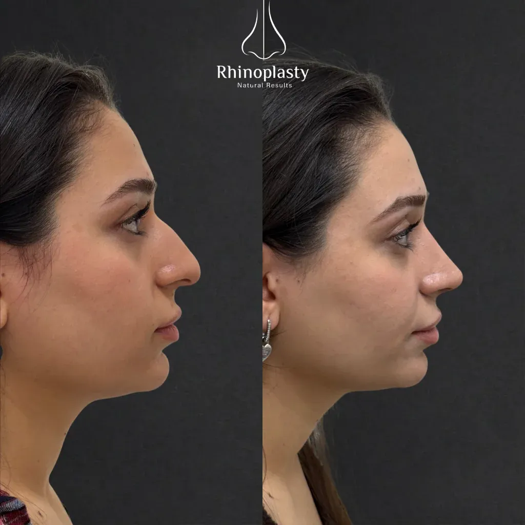 Rhinoplasty before and after — published with the patient's written consent