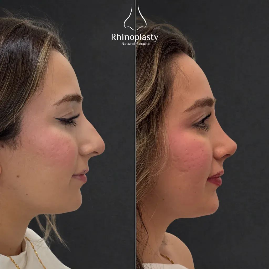 Rhinoplasty before and after — published with the patient's written consent