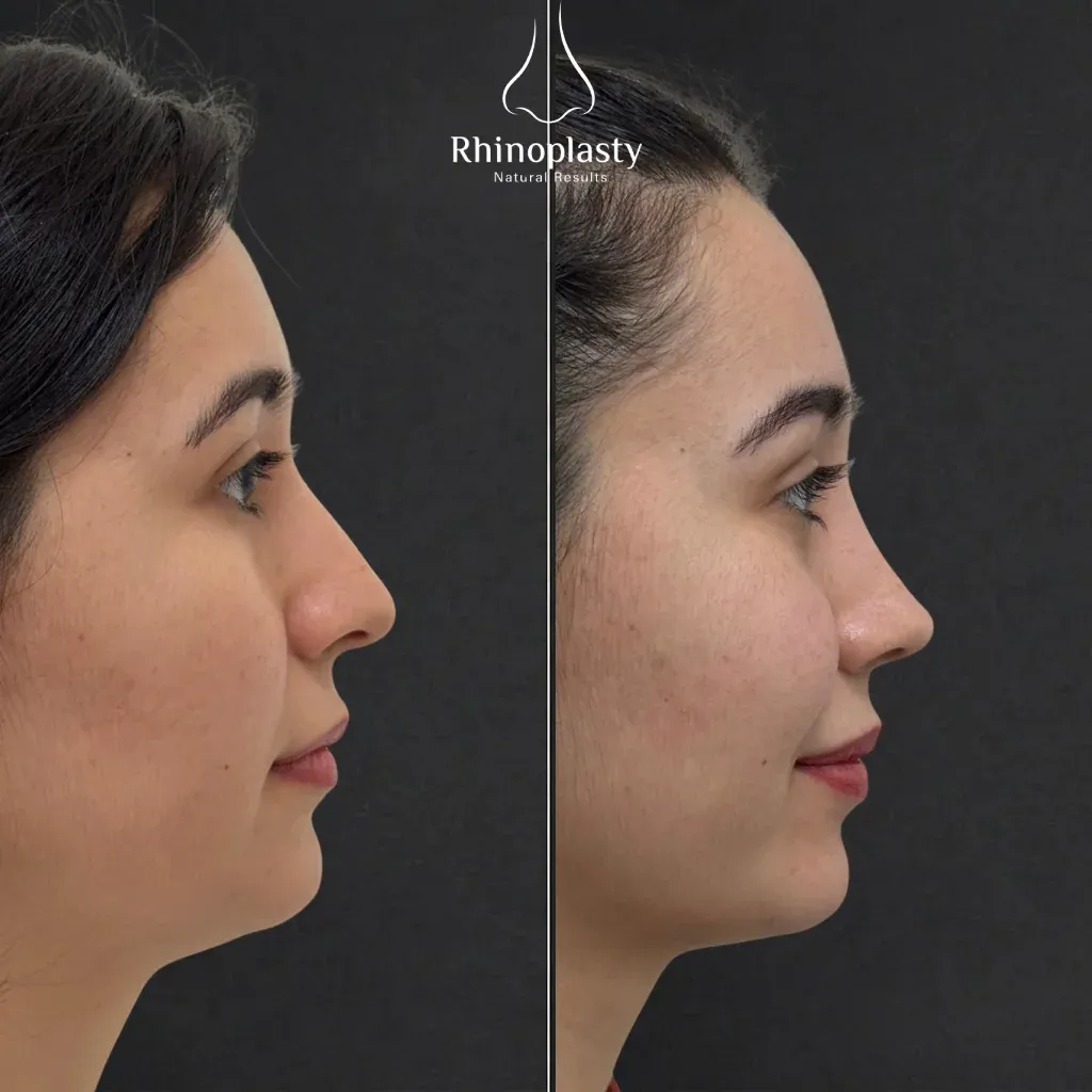 Rhinoplasty before and after — published with the patient's written consent