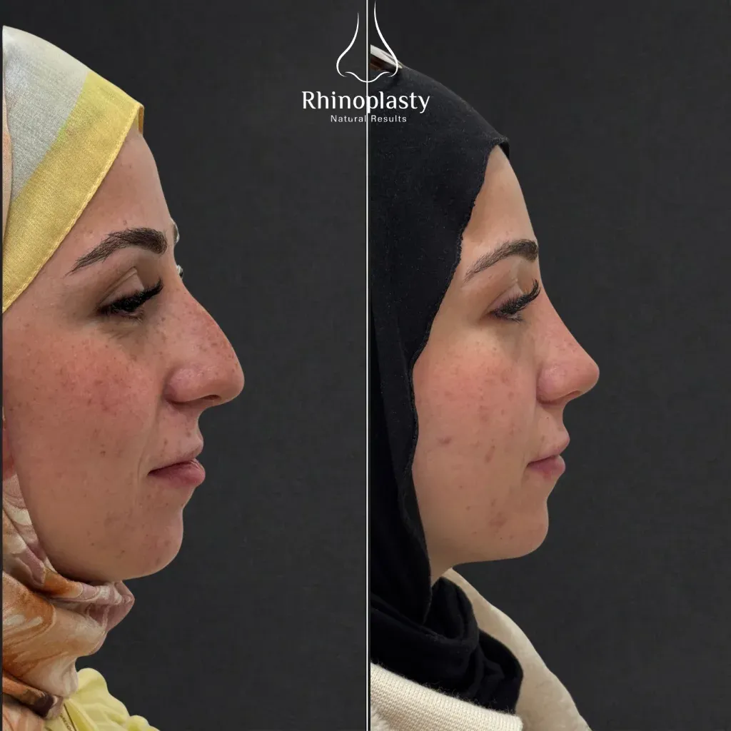 Rhinoplasty before and after — published with the patient's written consent