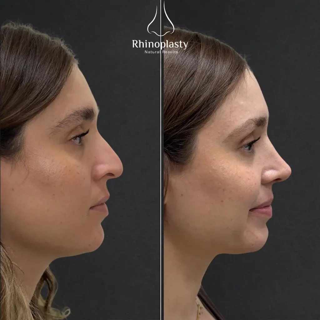 Rhinoplasty before and after — published with the patient's written consent